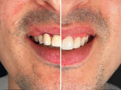 Before & After