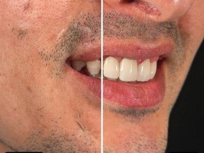 Before & After