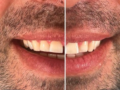 Before & After