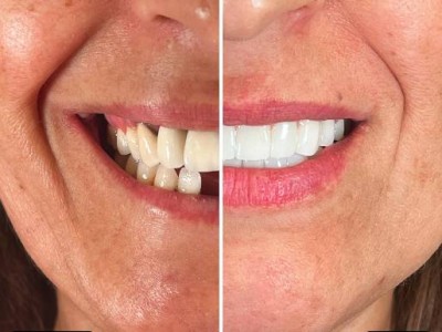 Before & After