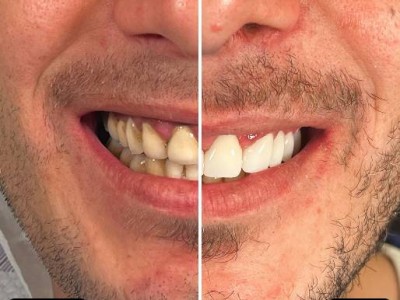 Before & After