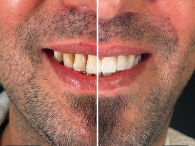 Before & After