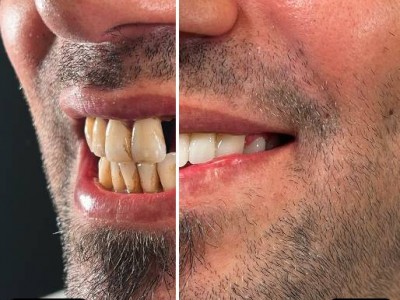 Before & After