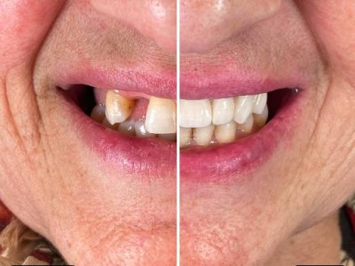 Before & After
