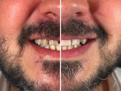 Before & After
