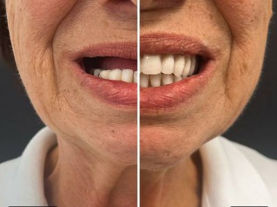 Before & After