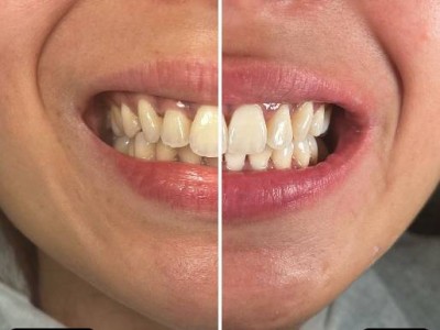 Before & After