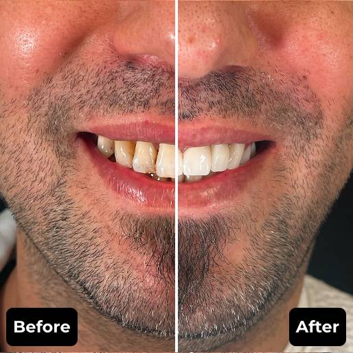 Before & After